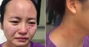 Covid-19 Patient who refused treatment, bites nurse in the face