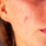 Anxiety caused by acne: what are the causes and what can be done about it?