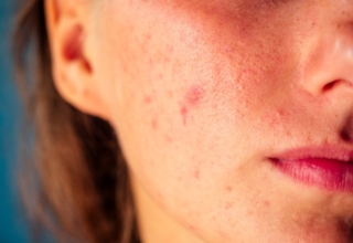 Anxiety caused by acne: what are the causes and what can be done about it?