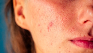 Anxiety caused by acne: what are the causes and what can be done about it?