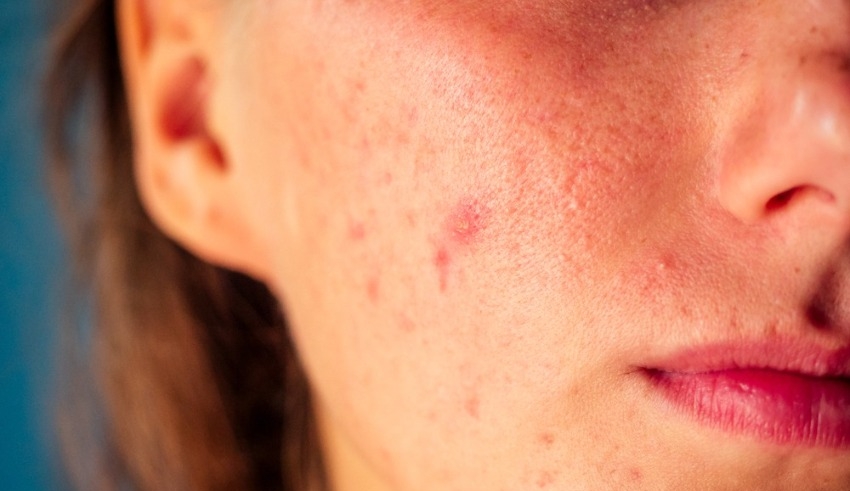Anxiety caused by acne: what are the causes and what can be done about it?