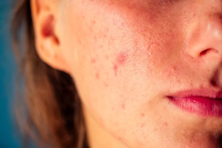 Anxiety caused by acne: what are the causes and what can be done about it?