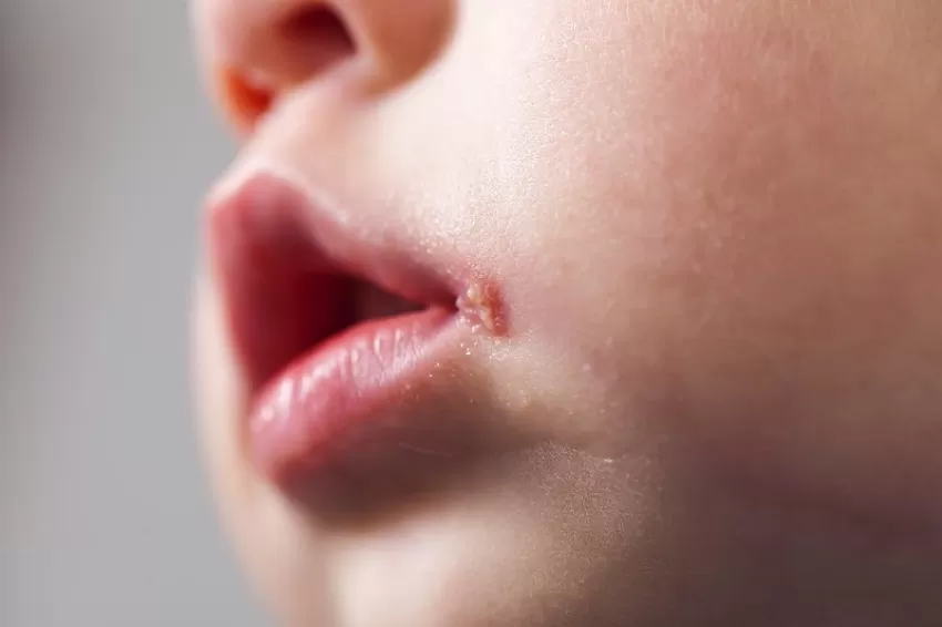 Indonesia has begun immunizations against foot and mouth disease across the country