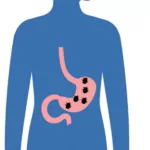 don't let h. pylori take over test and treat to reduce stomach cancer risk