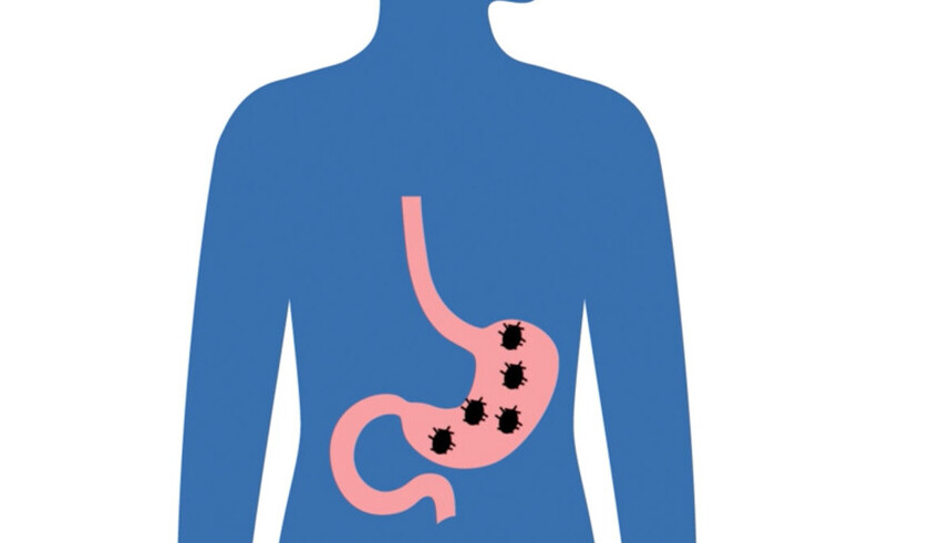 don't let h. pylori take over test and treat to reduce stomach cancer risk