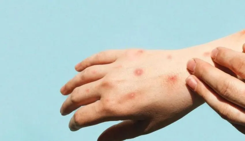 Uncertainties Surround the Rapidly Evolving Mpox Strain in Africa